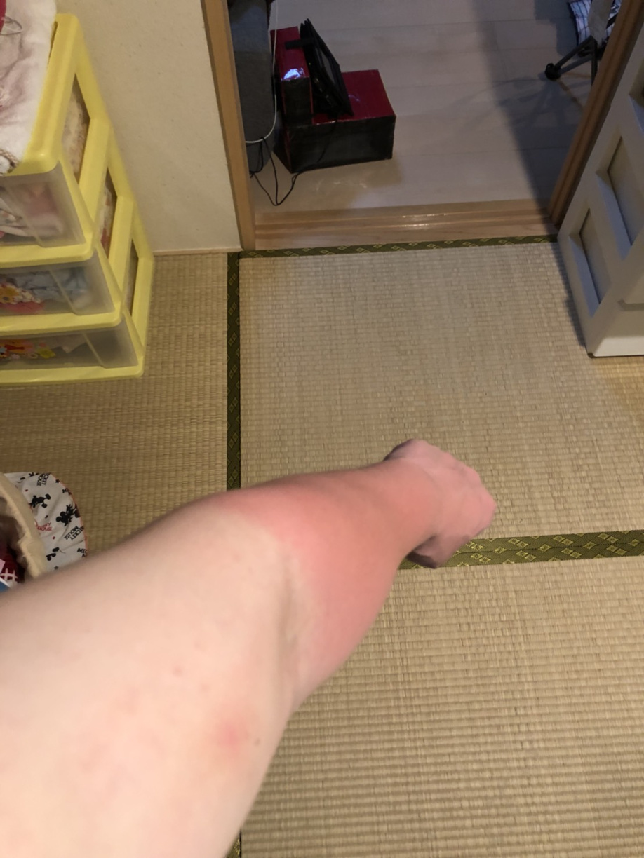 潮干狩りにて真っ赤に日焼けした腕