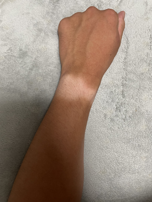 日焼けの画像